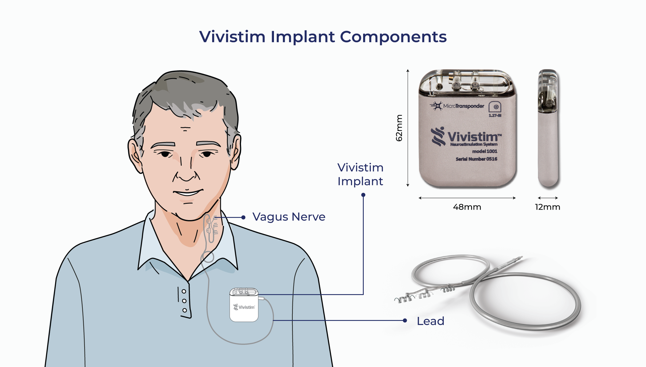 Vivistim implant components showing the chest implant, lead, and vagus nerve location